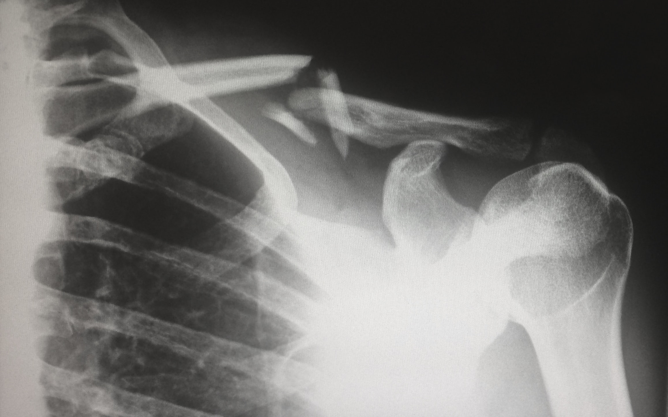 black and white x-ray of broken bones