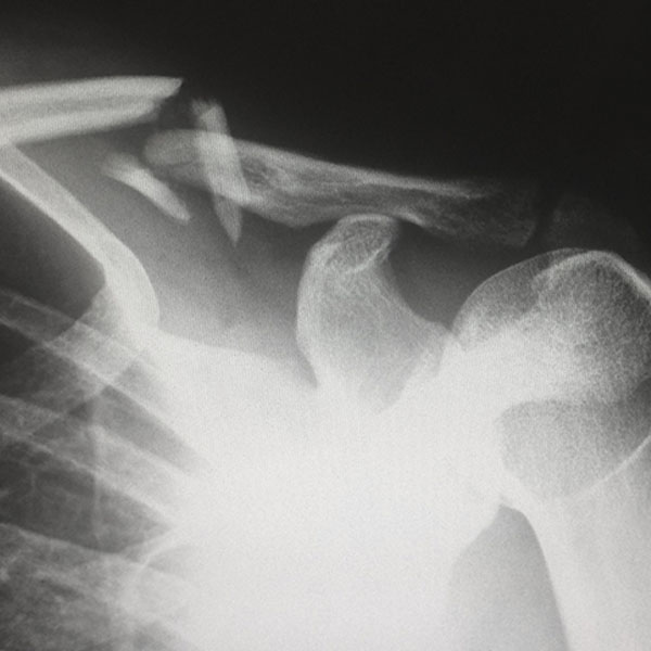 black and white x-ray of broken bones from a workers compensation injury