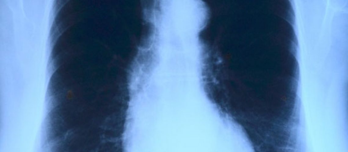 mesothelioma-charlotte-workers-compensation-lawyer